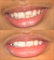 smile zone