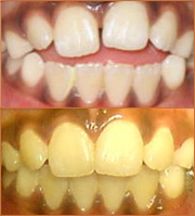 smile zone